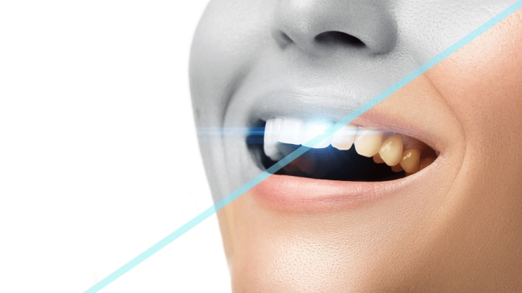 Markham dentist - Teeth Whitening