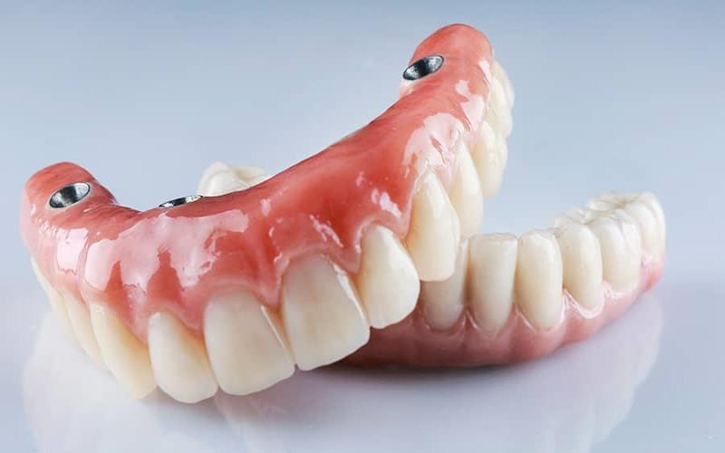 Are Implant Dentures Proper for You? Elements to Think about Earlier than Making a Choice in Buffalo Grove, Illinois